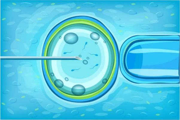 ไขคำตอบ! การทำ IUI คืออะไร เหมาะสมกับใครบ้าง 